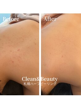 クリーンアンドビューティ 札幌(Clean&Beauty)/背中ニキビ予防にもハーブを♪