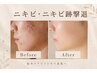 【凸凹肌・毛穴】ニキビ/速攻2Bハーブピーリングでクリアな肌に　￥19800