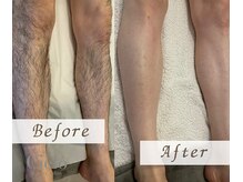 シエロ 上野店(Cielo)/『部分脱毛も可能です』