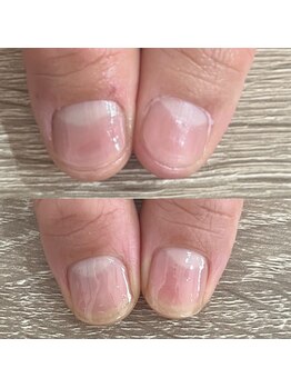 ウェルズユキ(well's yuki)/二枚爪 角が欠ける