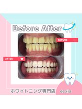 エクシアホワイトニング 札幌中島公園店/BeforeAfter［ホワイトニング］ 