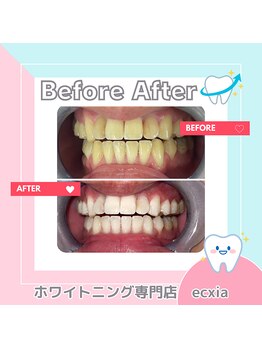 エクシアホワイトニング 札幌中島公園店/BeforeAfter［ホワイトニング］ 