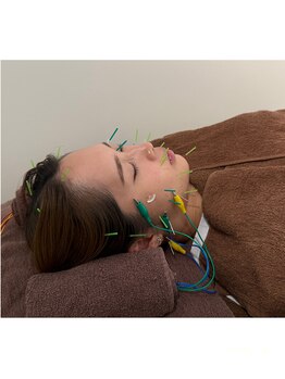 トイ鍼灸接骨院(TOY鍼灸接骨院)/●美容鍼