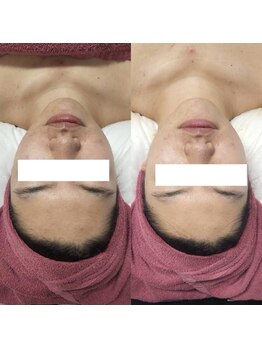 リーインカーナ アーティスト(REINCARNA ARTIST)/くすみ改善【ハーブピーリング】