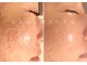 ココビ(COCOVi)の写真/【ニキビケア・毛穴悩みに】敏感肌もOKのプラズマ☆毛穴のざらつきを根本ケアして、滑らかな素肌へ♪