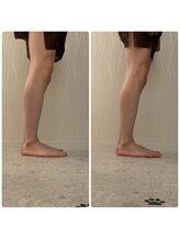 ソルニス(Solnis.)/痩身☆脂肪分解/ハイパーナイフ