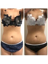 リボディ プラチナ(Rebody platinum)/脂肪冷却×ボディケア