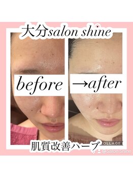サロンシャイン(Salon Shine)/ハードハーブピーリング１回