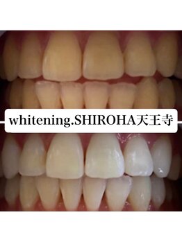 シロハ(SHIROHA)/セルフホワイトニング/天王寺