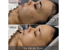 ラヴィアンローズ 岐阜本店(La vie en Rose)の雰囲気（ILLONハーブピーリング　2回施術）