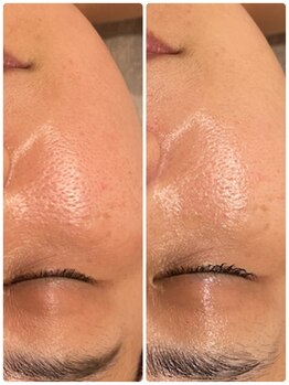 ファビリス 天王寺店(FAVILIS)/ACトリートメント1回/50代