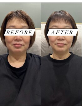 シロ(silo.)/メデューサと耳つぼbefore after