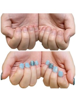 ブルームブルーム(BLOOMブルーム)/お洒落しながら深爪矯正