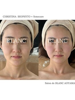 サロン ド ブラン アオヤマ(Salon de BLANC AOYAMA)/BIOPHYTO×Sonocare