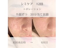 ニコ ウィズ(Nico with)の雰囲気（肌負担がなく、施術後からメイクOK♪コンシーラーいらずの肌に◎）