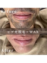 エピナ 横浜店(Epina)/メンズひげ脱毛/ヒゲ脱毛/髭脱毛