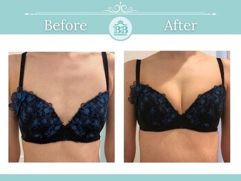 美人バスト 小倉店/バストアップ◇症例◇