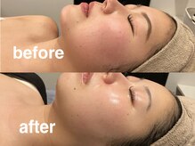 ヴィセラ(Vicella)/一回施術で艶ツヤ肌に！