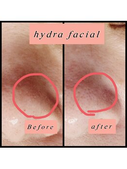 ティアメディカル(Tia Medical)/ハイドラフェイシャル