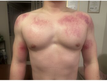 サロン マイワン(Salon MyONE)/アスリートに筋膜リリース