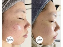 ルーム(lume)/ハーブピーリング before/after