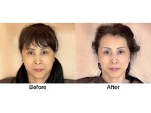 こじま 富雄団地接骨院/目の下のたるみ改善