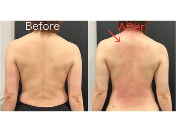 スパチャーレ(Spa ciare)/【トーンヌール】before & after
