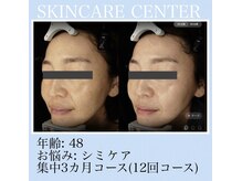 アンジェラックス スキンケアセンター心斎橋/48歳　シミ美白ケア