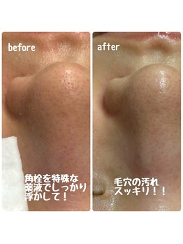 クラリ(Clari)/毛穴/毛穴ケア/ハイドラ