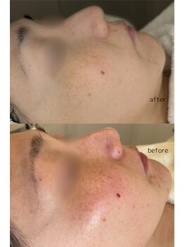 ララ オートクチュール(LALA HAUTOCOUTURE)/赤味/シミ/くすみ