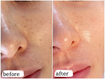 カピリナスパ(Ka.Pilina Spa)/毛穴洗浄★ before⇒after