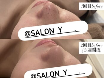 サロンワイアネシス(Salon y ANESIS)/ハーブピーリング