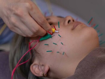 栄光治院 岡崎南院の写真/<痛みの少ない美容鍼>で肌の質を改善!シワ・たるみ予防/ニキビケア/お顔の引き締め/首肩コリ緩和などに◎