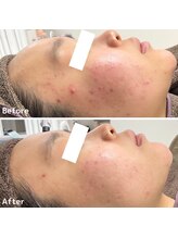 ニキビ研究所 浦和店/頬の赤み・ほほニキビケアに！