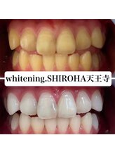 シロハ(SHIROHA)/セルフホワイトニング/天王寺