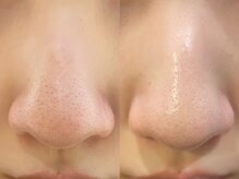 OBS新潟整骨院/毛穴黒ずみ改善♪