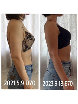 サチ(Sachi)/2人の出産後にバストに悩む