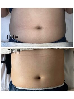 オリス(ORRIS)/ビフォーアフター(お腹)