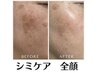 【シミケア】隠すから「消す」シミ改善フォト美顔→全顔￥17,100