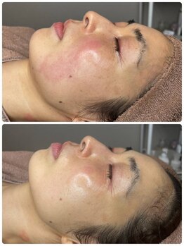 プライベートエステティックサロン アメジスト(AMETHYST)/ララピールbeforeAfter　４