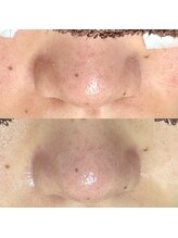 エクラ バイ シャンリィ(eclat by shanLy)/頑固な毛穴汚れにも