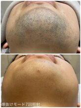 ヒスイ バイ アメイジング(Hisui by AMAZING)/【光脱毛】男性髭 &nbsp;IPL &nbsp;&nbsp;爆抜け