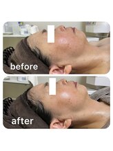 ルクール(Le Couer)/水素パック