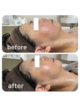 ルクール(Le Couer)/水素パック