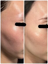 エステサロン 美飾り イオンモール木更津店/before⇒after/プラズマ