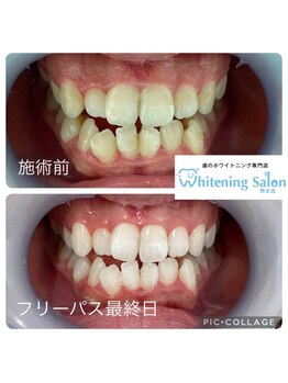 ホワイトニングサロン 熊本店/熊本ホワイトニング