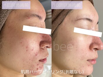 ハービー(Herbee)/剥けないハーブピーリングの症例