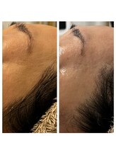 美温(mion)/こめかみの凹み