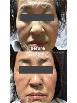 セレネ(SELENE)/ほうれい線、たるみ、老化肌