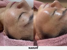 ナルムフェイシャル 代々木(NARUM facial)/白玉ピーリング